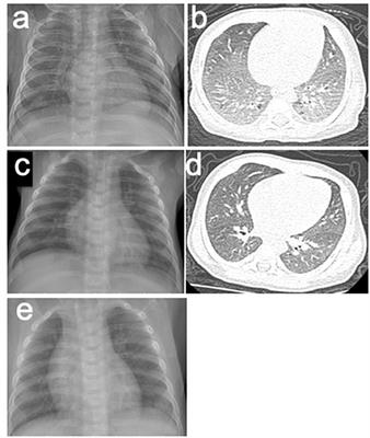 Hematochezia in a Child With Heiner Syndrome